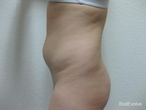 Liposuction - Patient 2 - Before 3