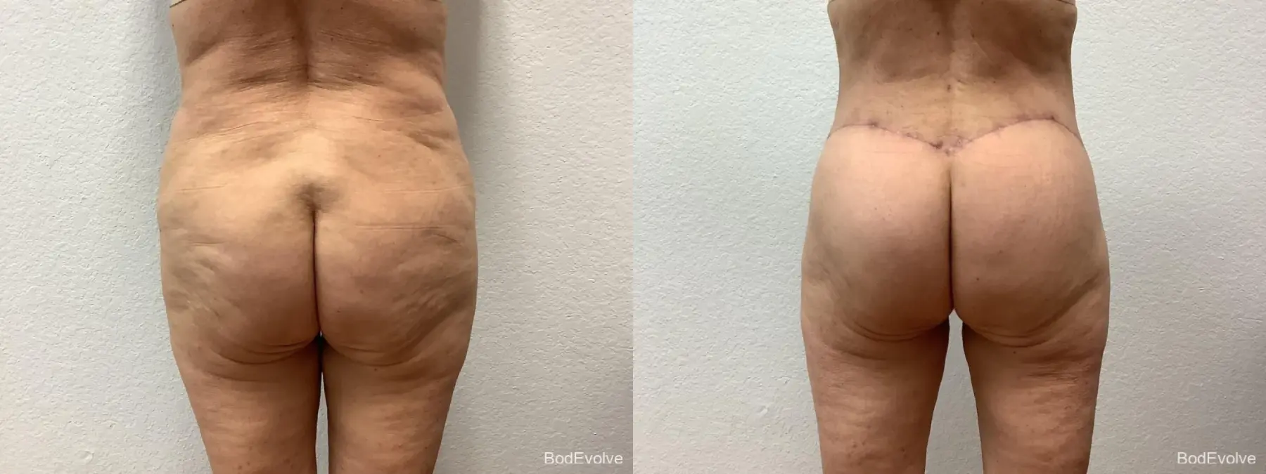 Back Lift: Patient 1 - Before and After  