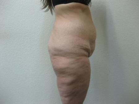Body Lift - Patient 8 - Before Image 2