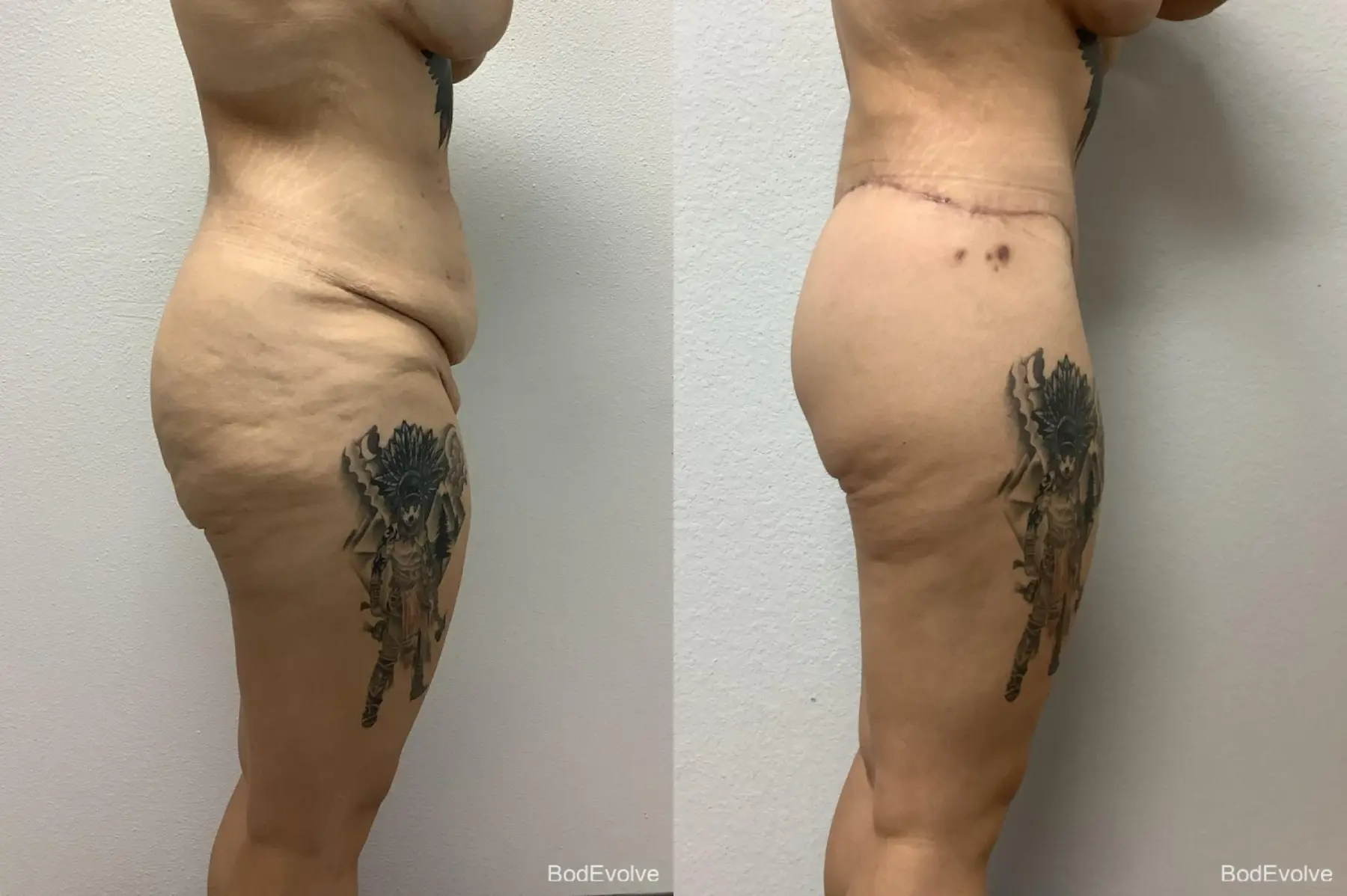 Body Lift: Patient 3 - Before and After 6