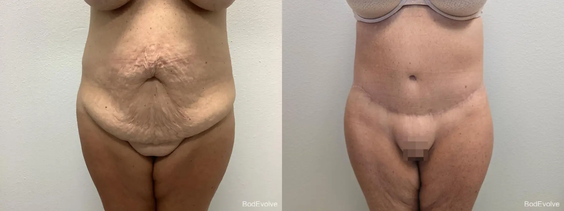 Body Lift: Patient 8 - Before and After  