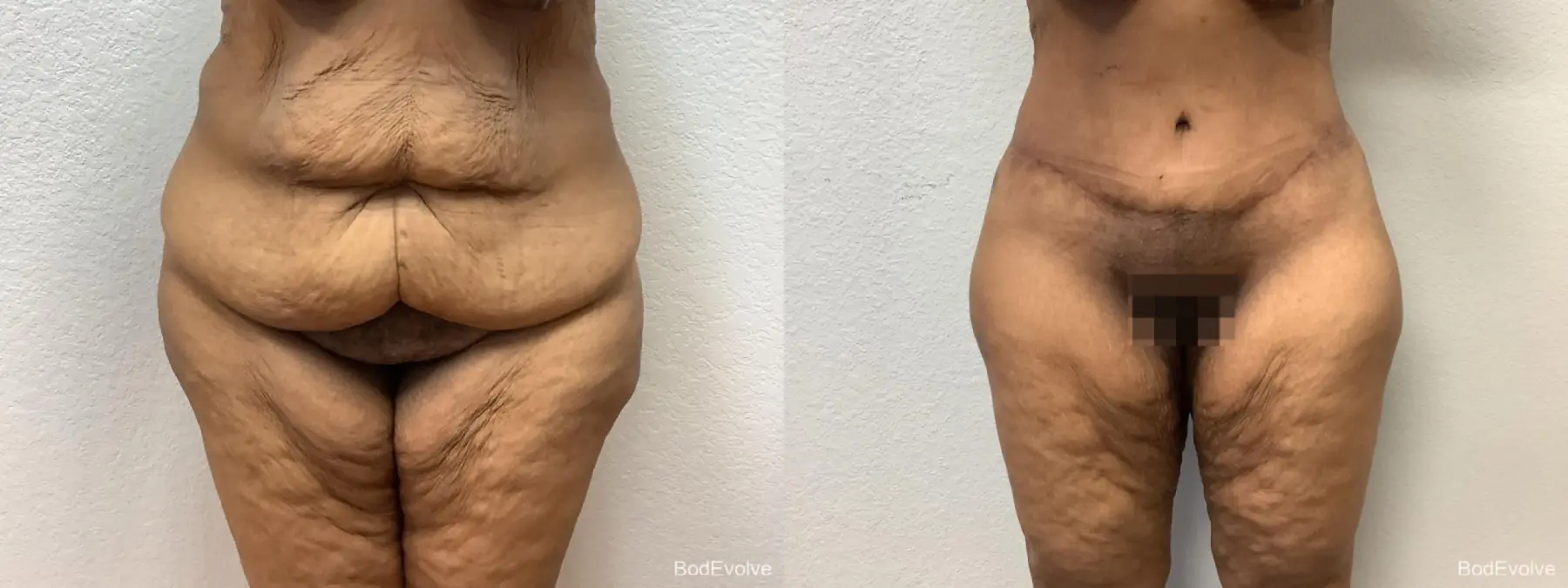 Body Lift: Patient 1 - Before and After  