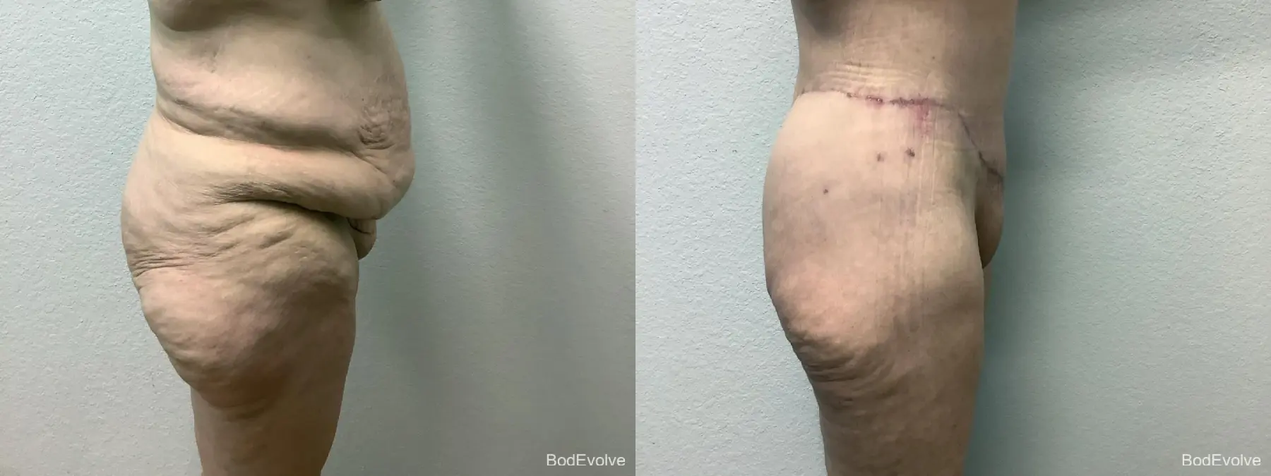 Body Lift: Patient 10 - Before and After 3