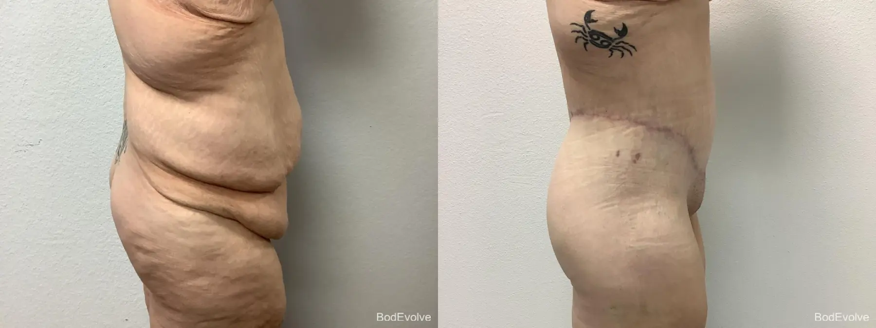 Body Lift: Patient 8 - Before and After 5