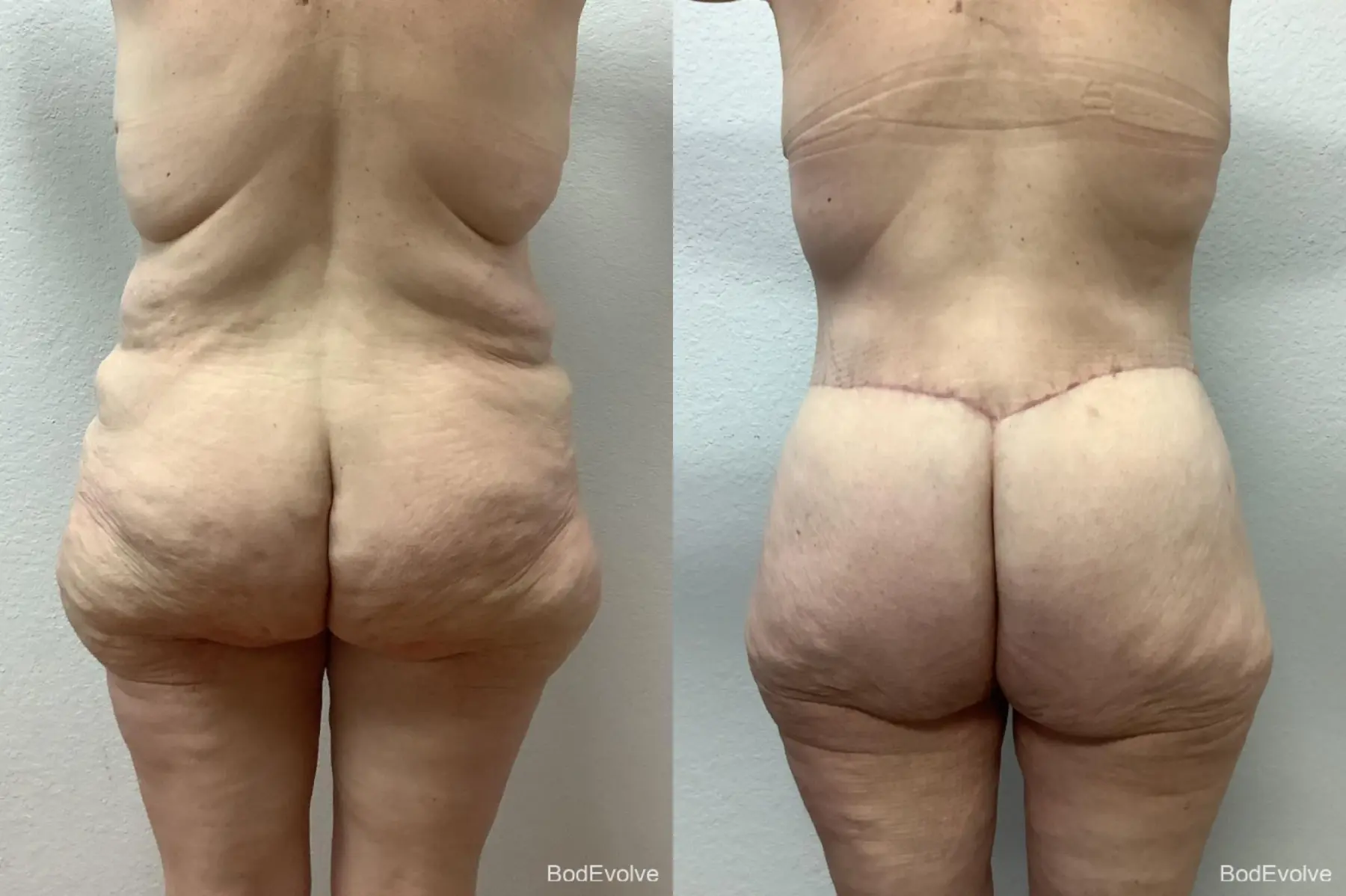 Body Lift: Patient 5 - Before and After 4