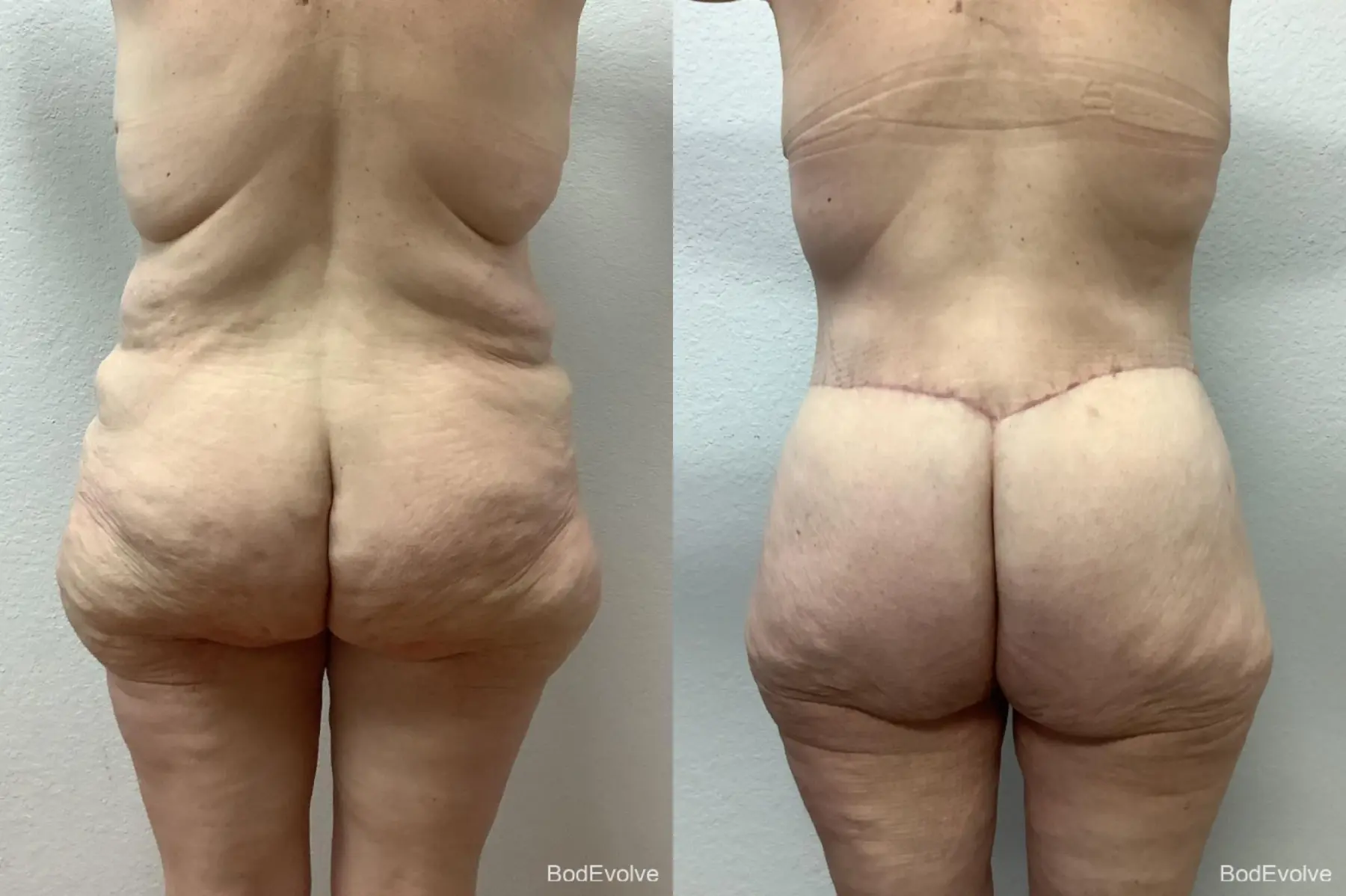 Body Lift: Patient 10 - Before and After 4