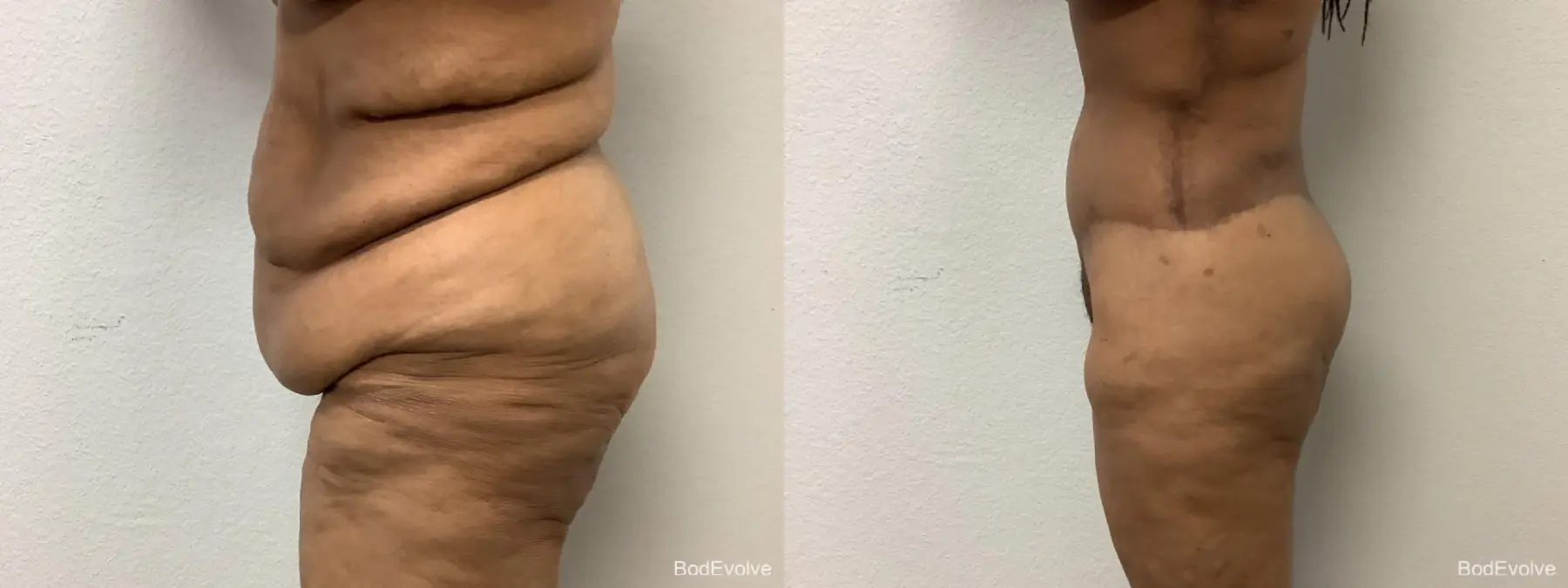 Body Lift: Patient 6 - Before and After 3