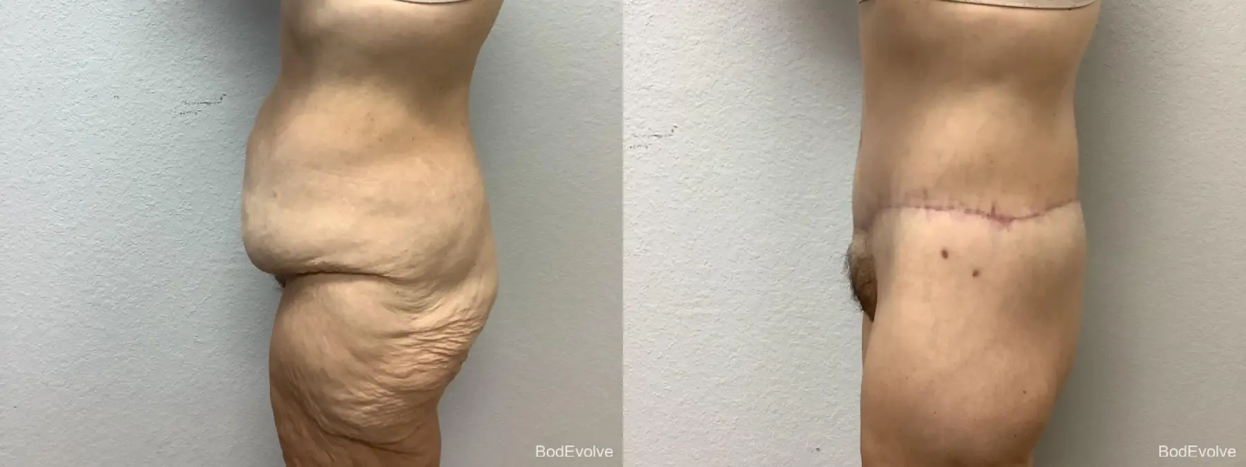 Body Lift: Patient 5 - Before and After 3