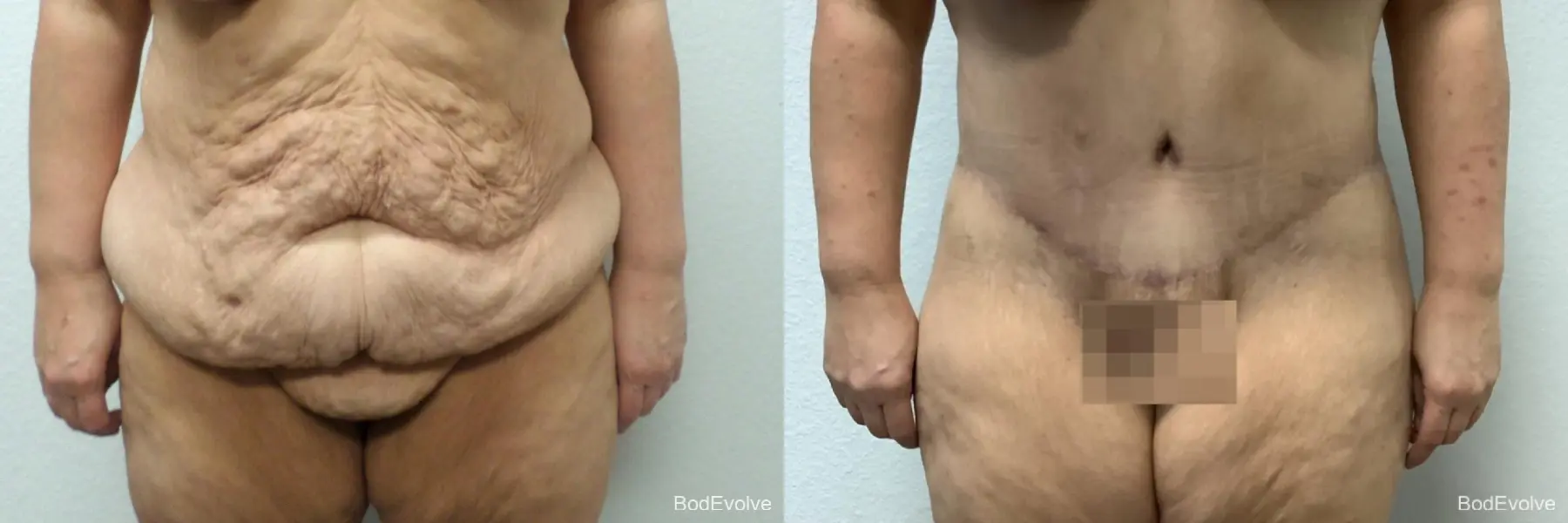 Body Lift: Patient 3 - Before and After 1