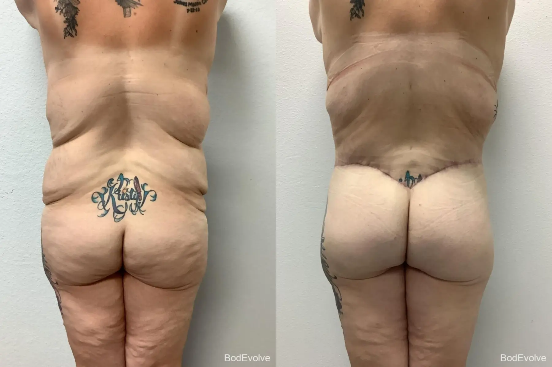 Body Lift: Patient 8 - Before and After 6