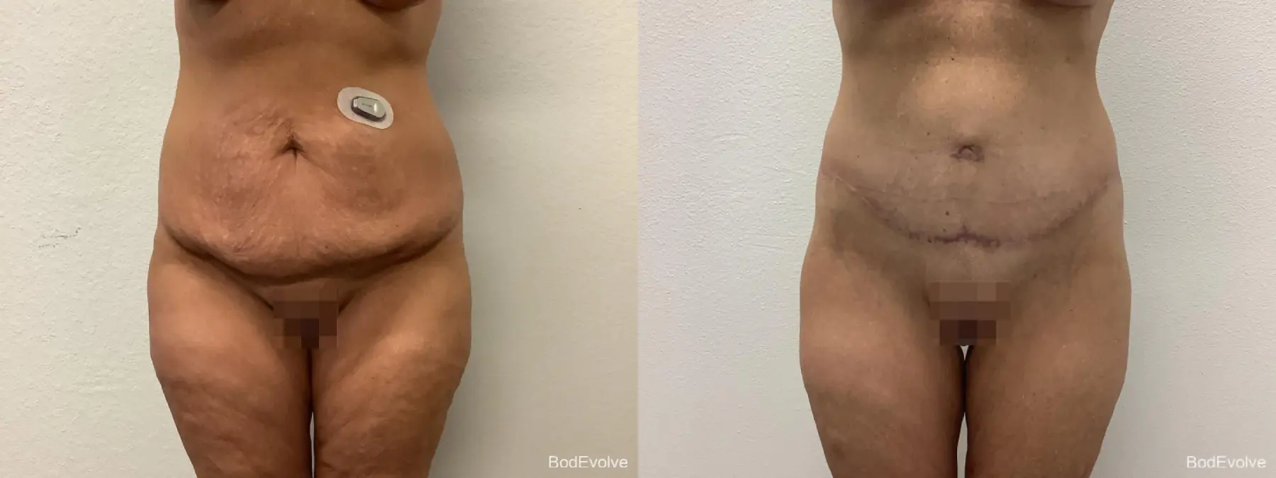 Body Lift: Patient 4 - Before and After  