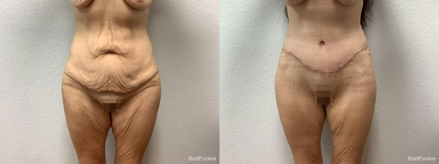 Body Lift: Patient 6 - Before and After  