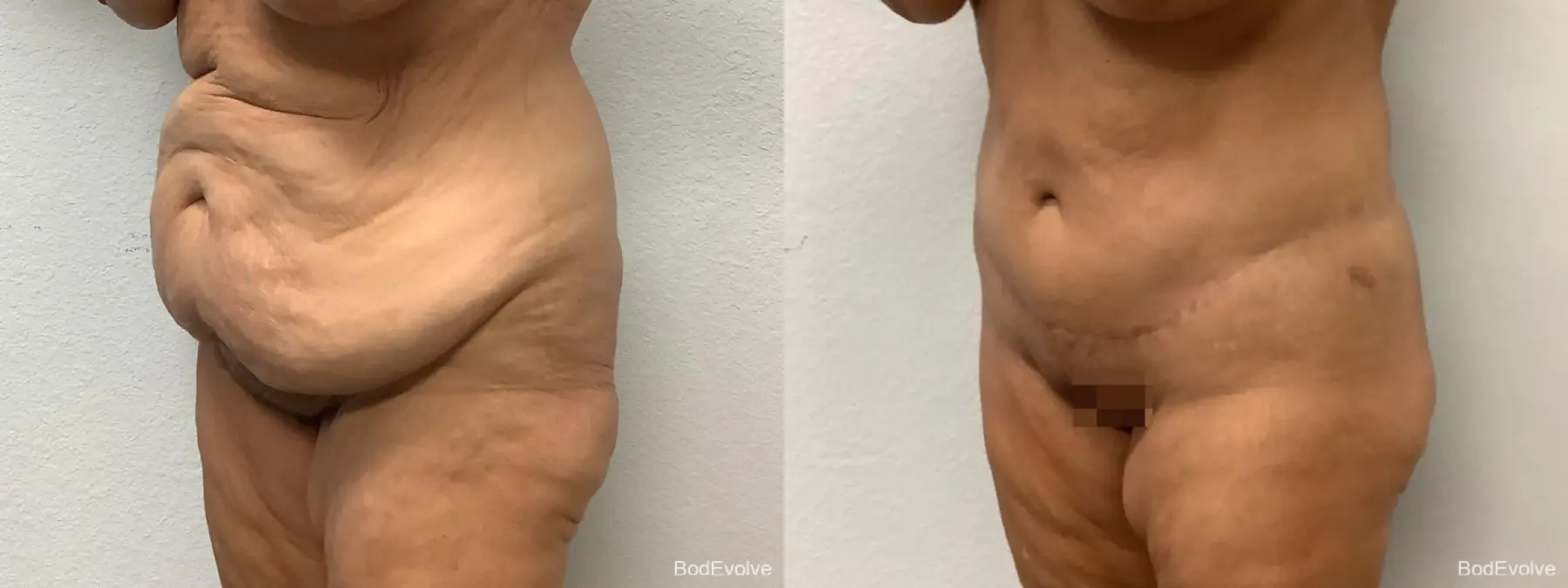 Body Lift: Patient 1 - Before and After 6