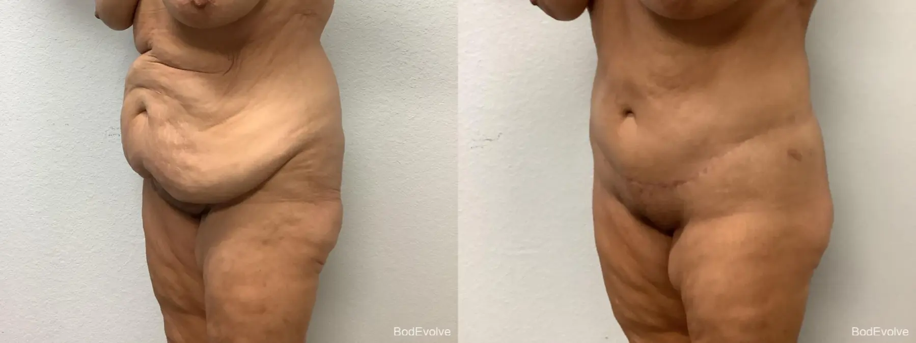 Body Lift: Patient 1 - Before and After 6