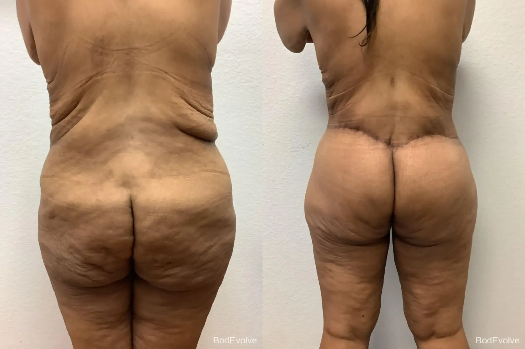 Body Lift: Patient 2 - Before and After 6