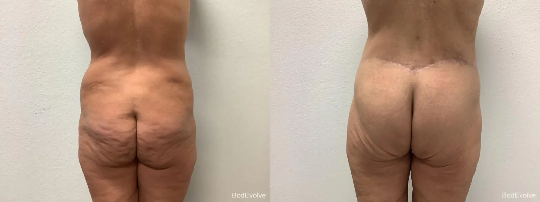 Body Lift: Patient 3 - Before and After 6