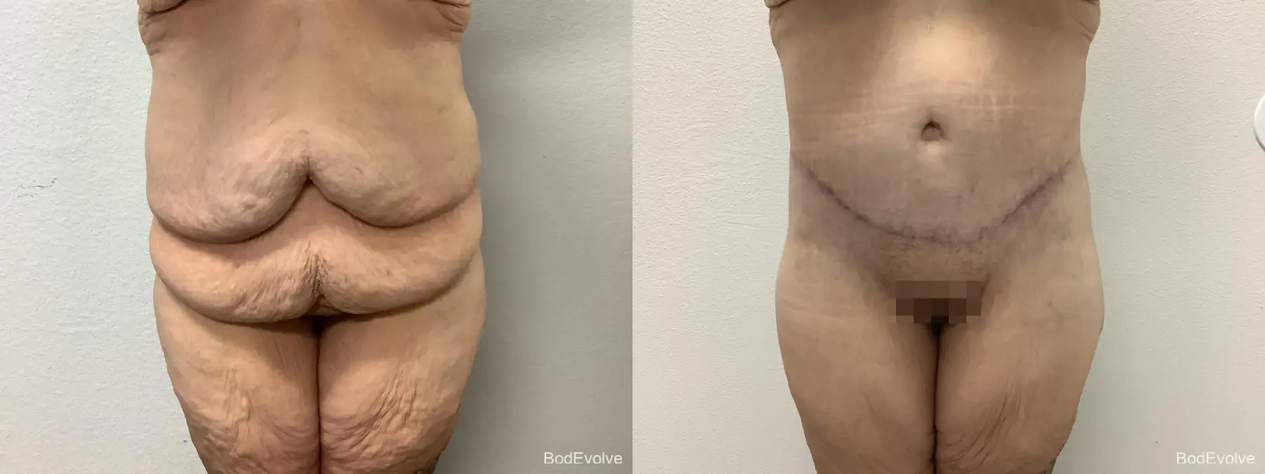 Body Lift: Patient 8 - Before and After  