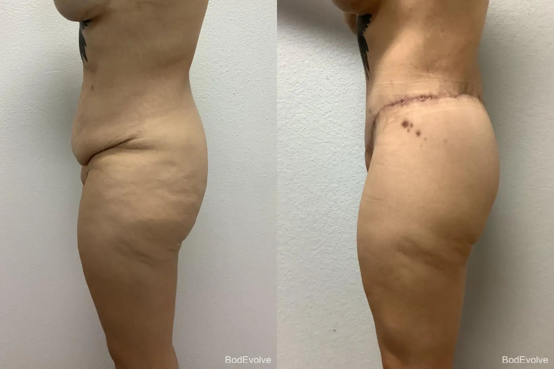 Body Lift: Patient 7 - Before and After 3