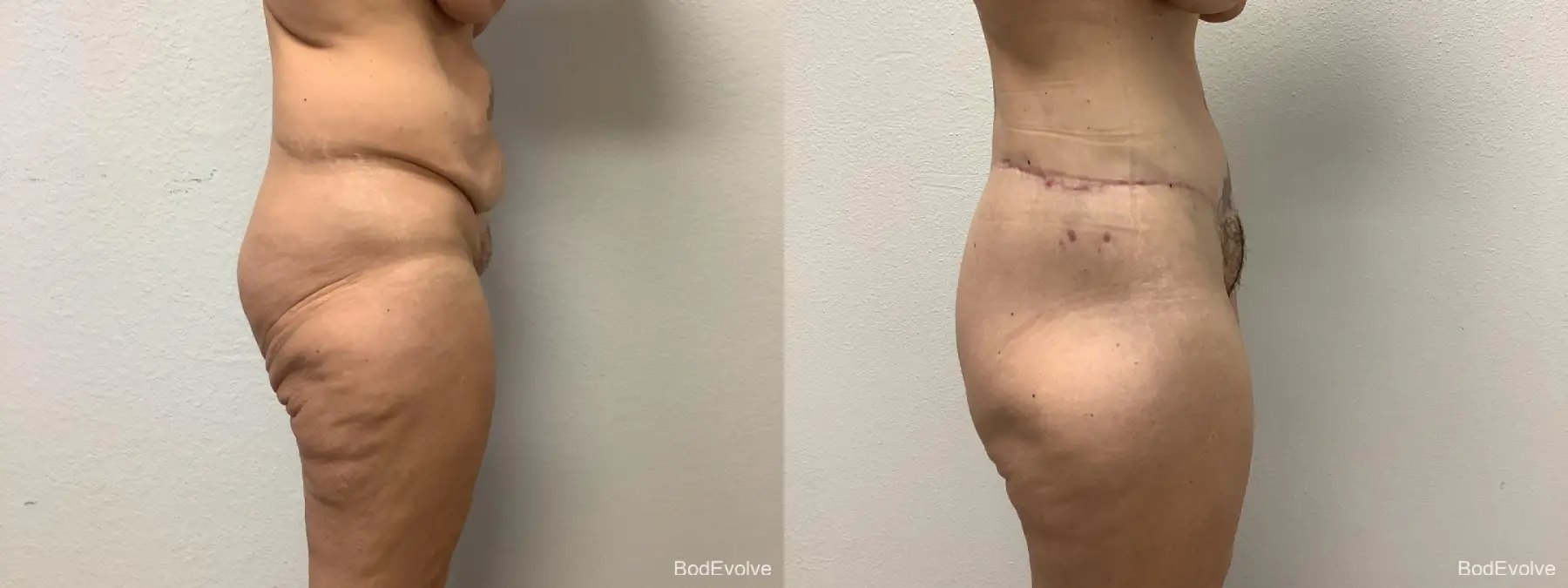 Body Lift: Patient 1 - Before and After 5