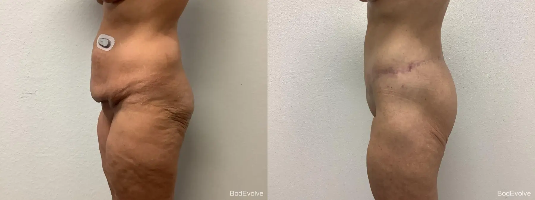 Body Lift: Patient 3 - Before and After 3