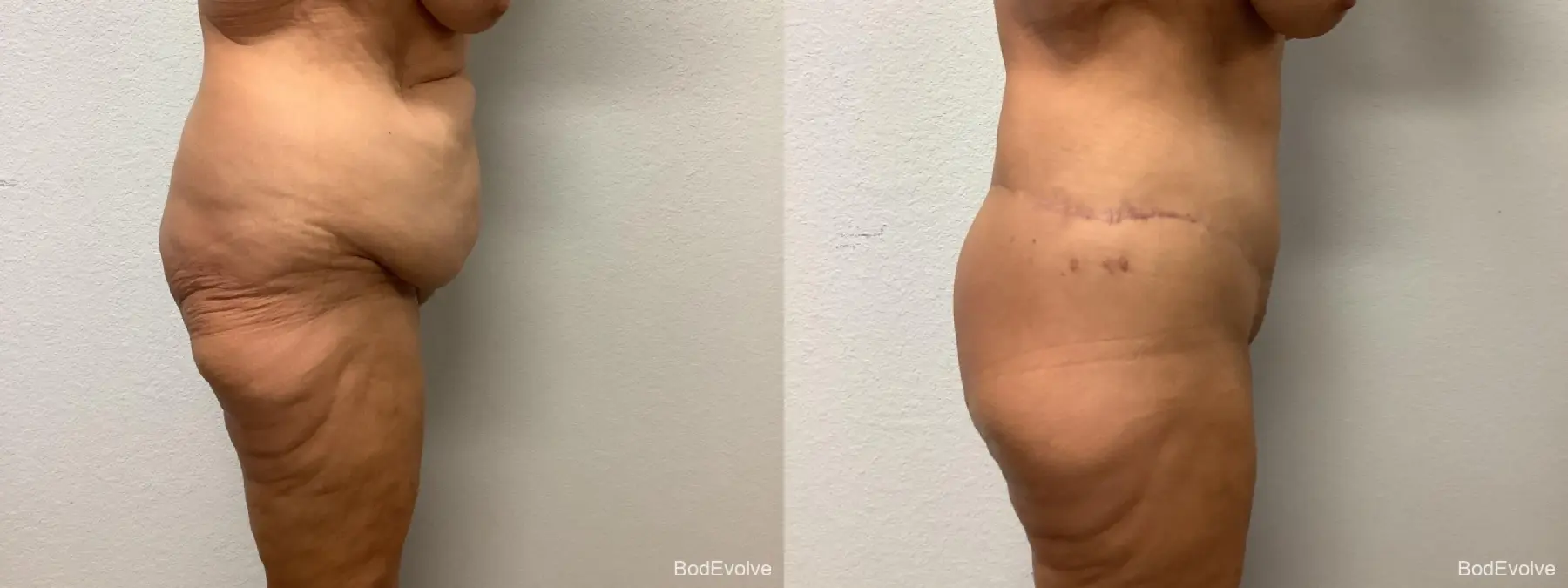 Body Lift: Patient 1 - Before and After 3