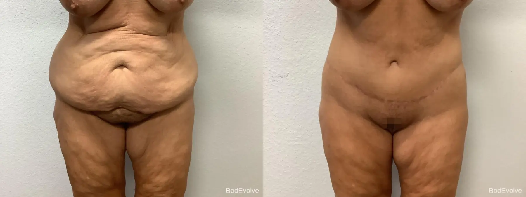 Body Lift: Patient 4 - Before and After  