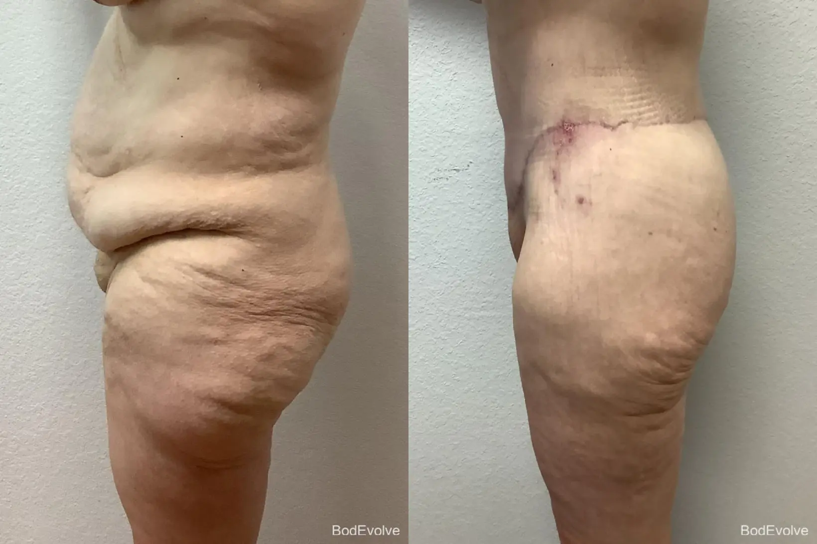 Body Lift: Patient 5 - Before and After 2