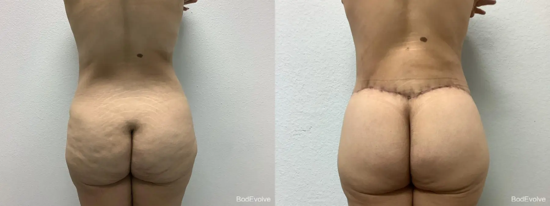 Body Lift: Patient 3 - Before and After 4