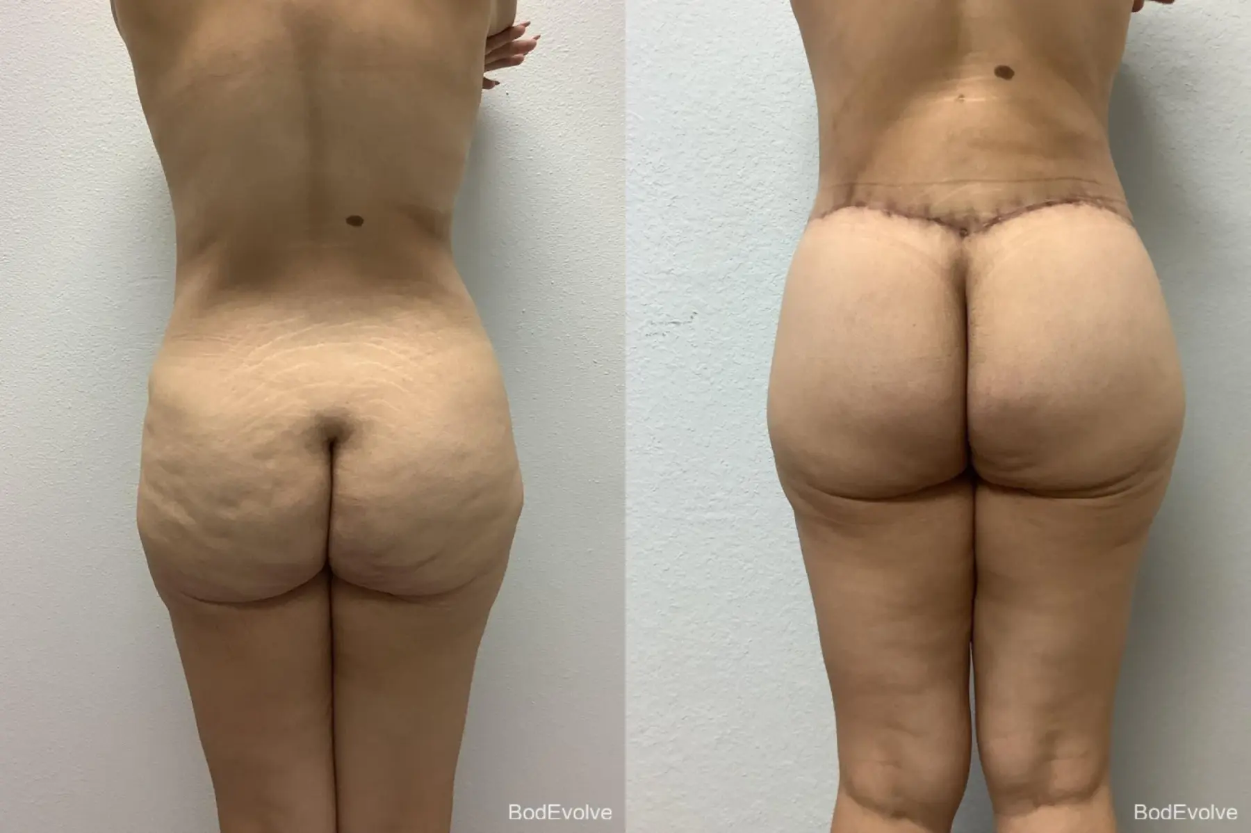 Body Lift: Patient 7 - Before and After 4