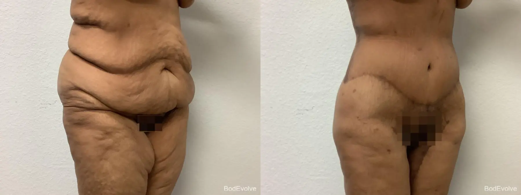 Body Lift: Patient 6 - Before and After 4