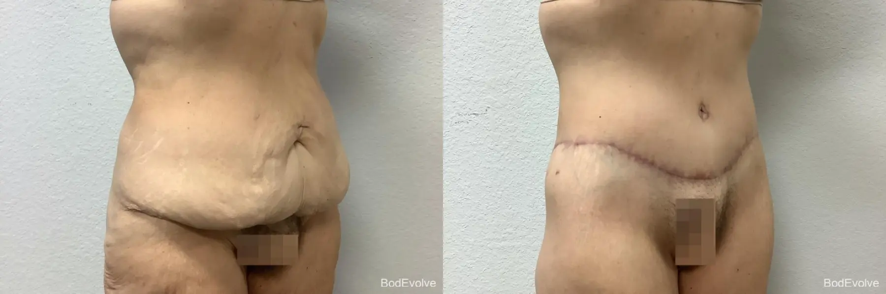 Body Lift: Patient 5 - Before and After 5