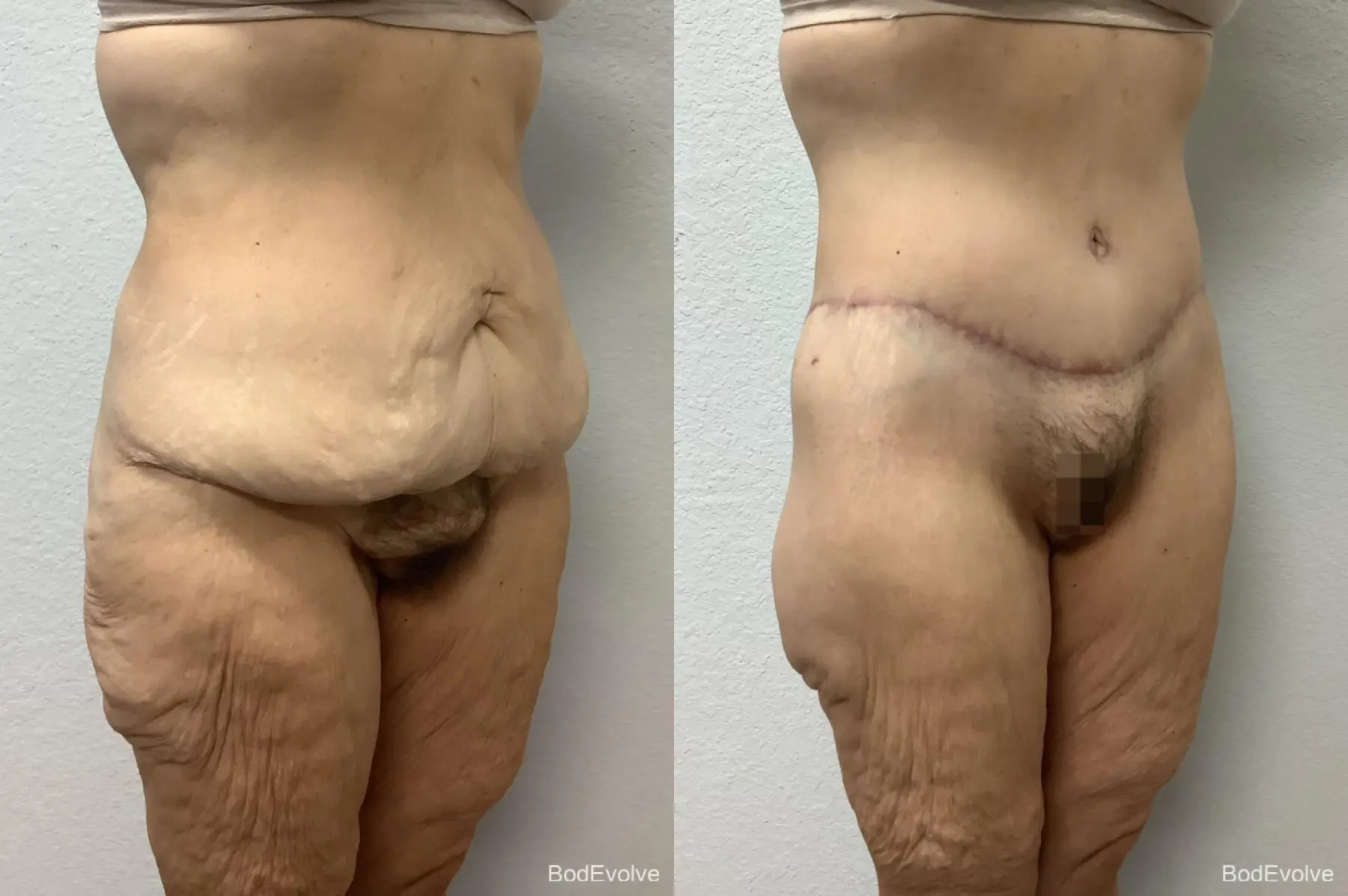 Body Lift: Patient 5 - Before and After 5