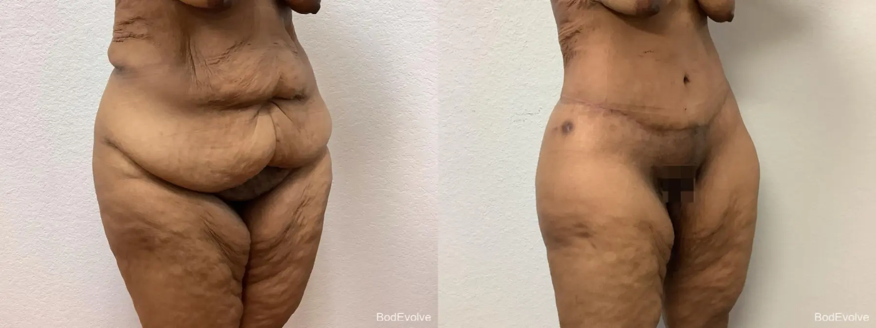 Body Lift: Patient 2 - Before and After 4