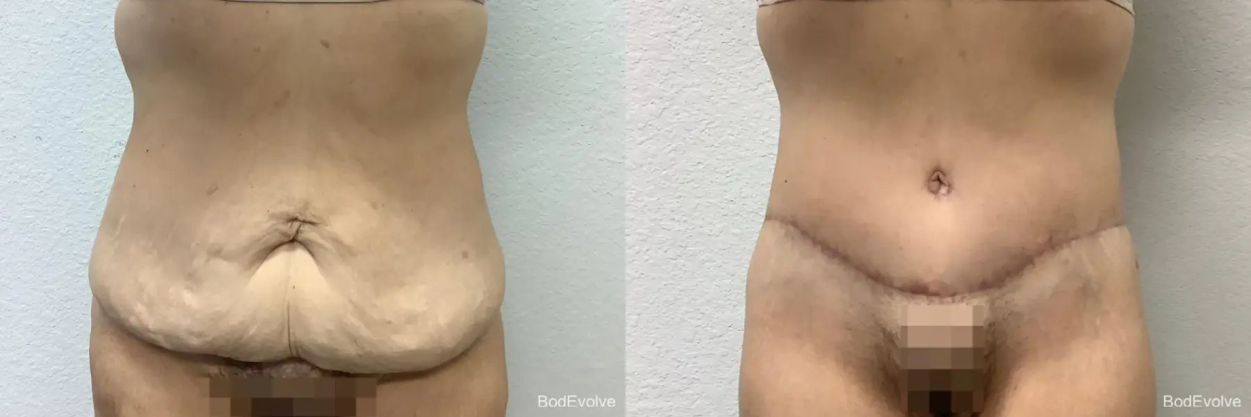 Body Lift: Patient 5 - Before and After 1