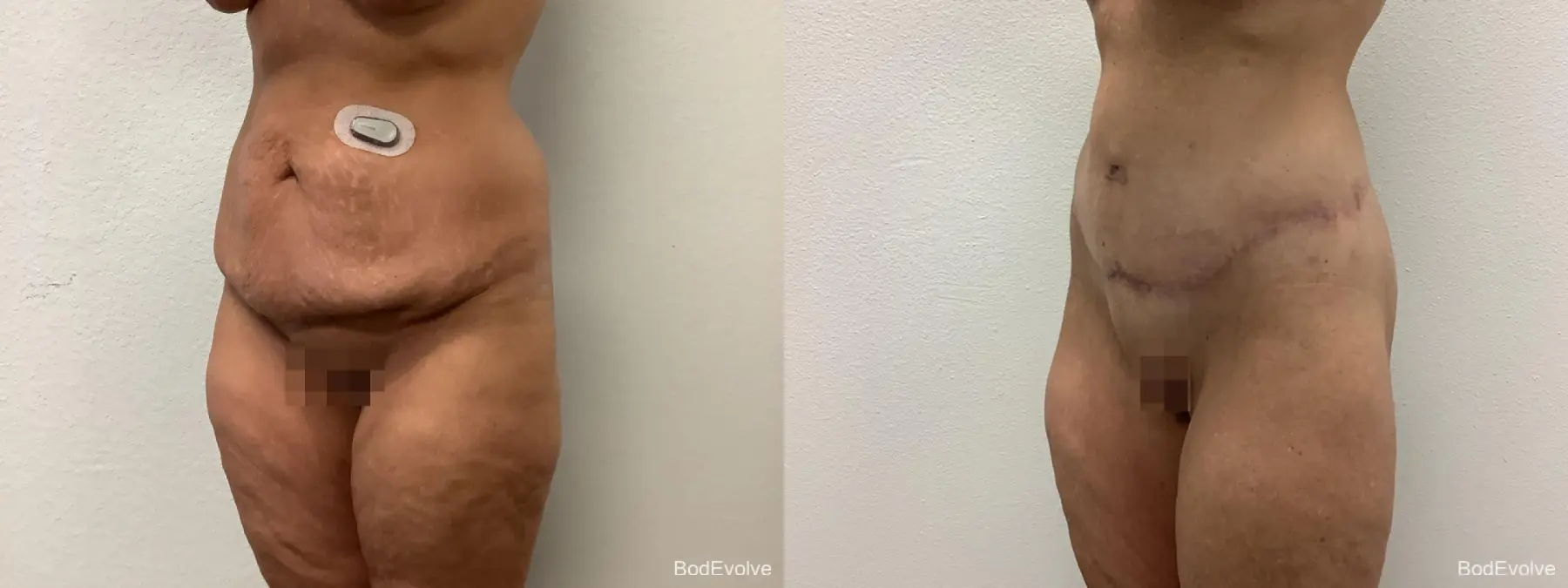 Body Lift: Patient 3 - Before and After 2