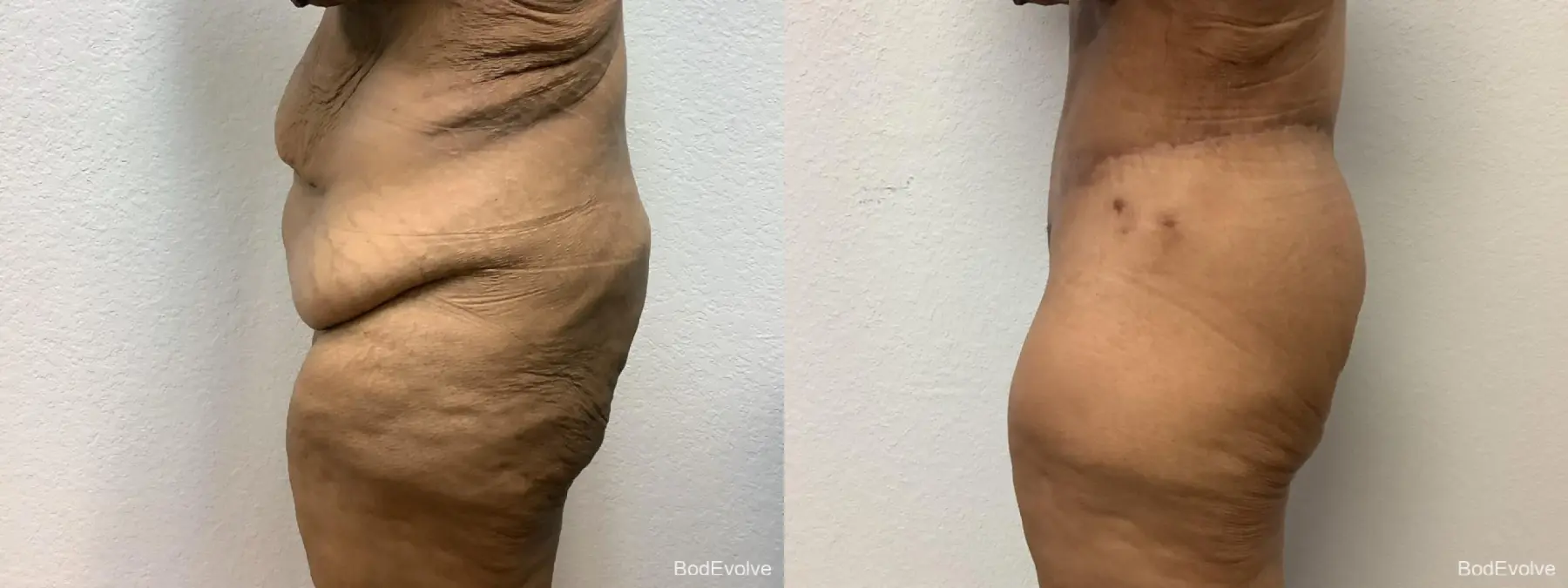 Body Lift: Patient 2 - Before and After 3