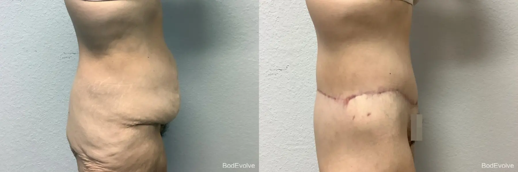 Body Lift: Patient 5 - Before and After 6