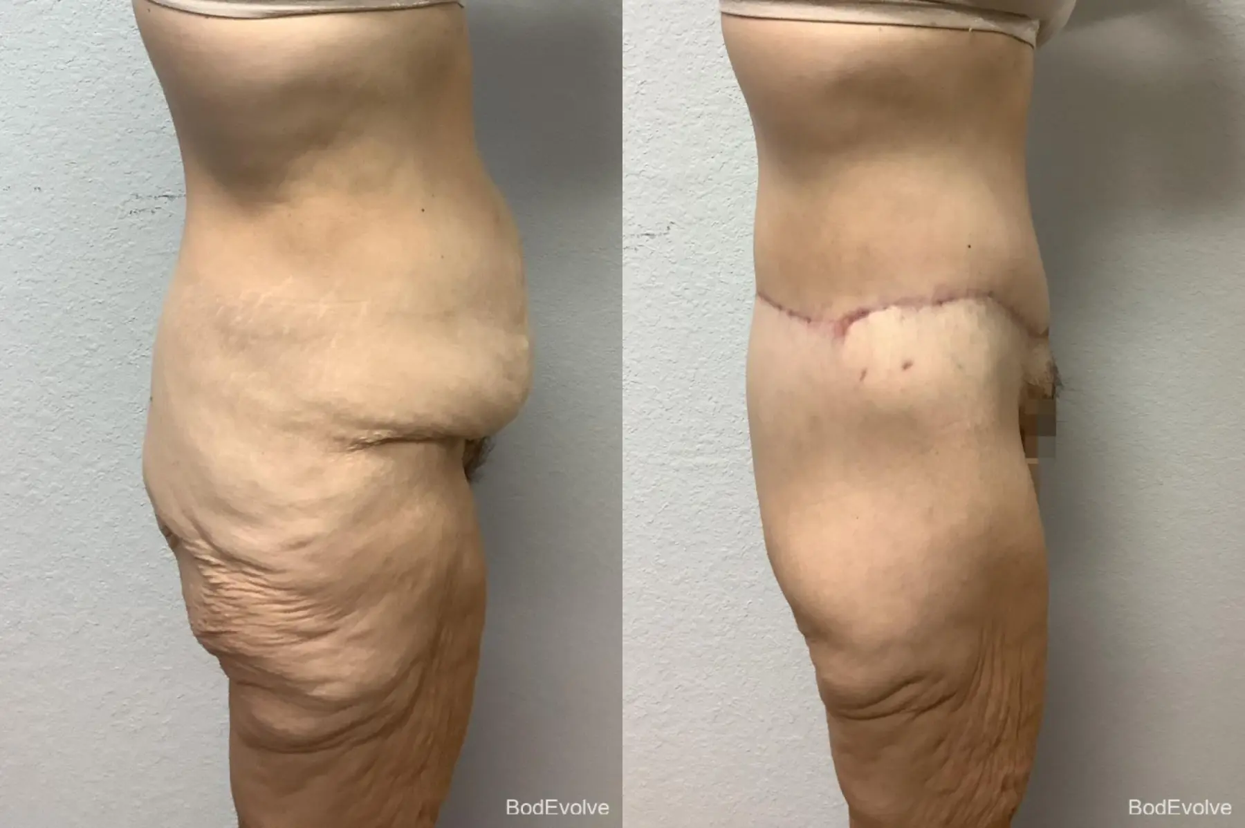 Body Lift: Patient 5 - Before and After 6