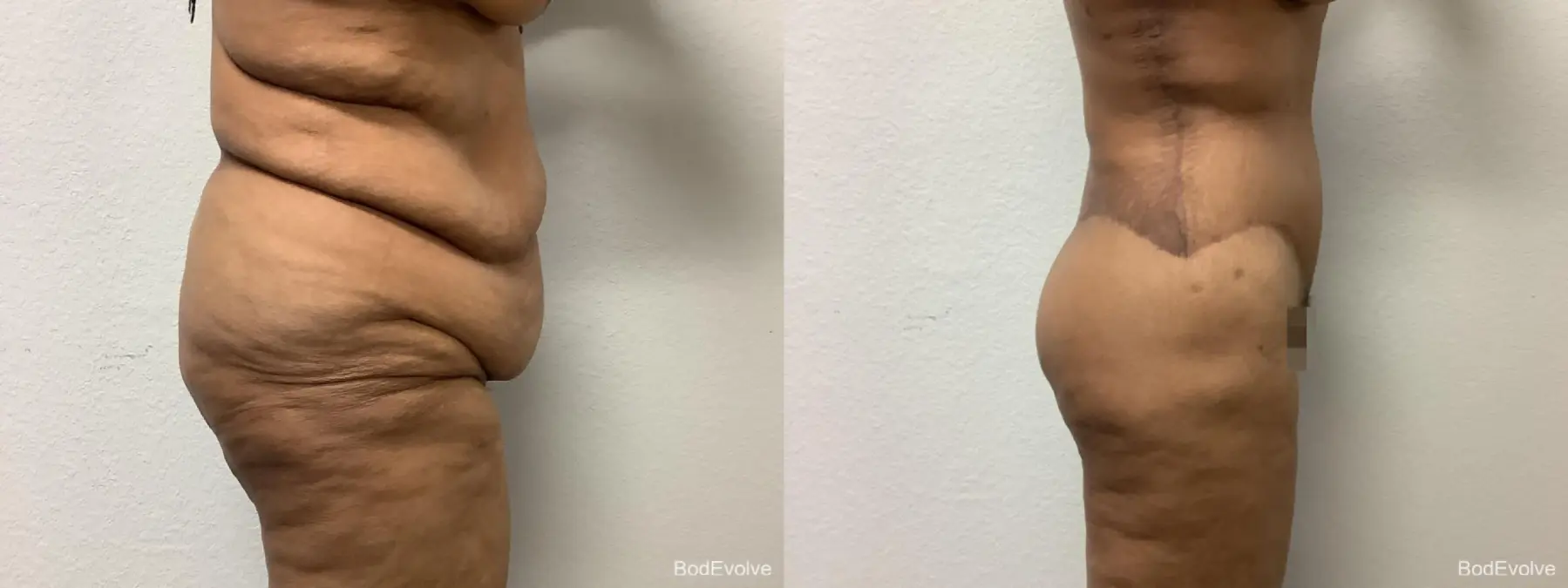 Body Lift: Patient 6 - Before and After 5