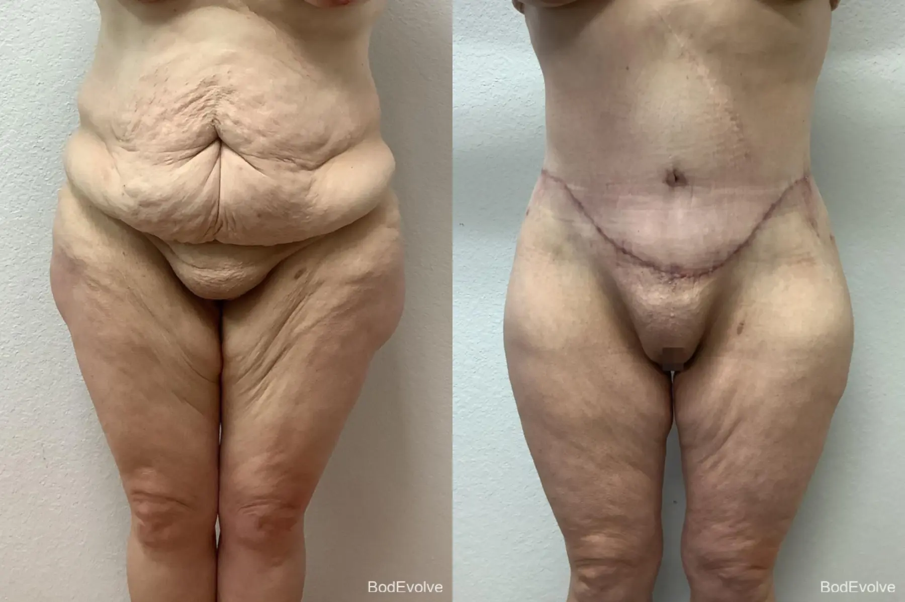 Body Lift: Patient 5 - Before and After 1