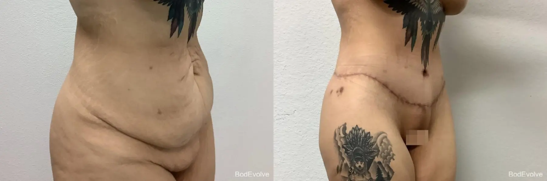 Body Lift: Patient 2 - Before and After 5