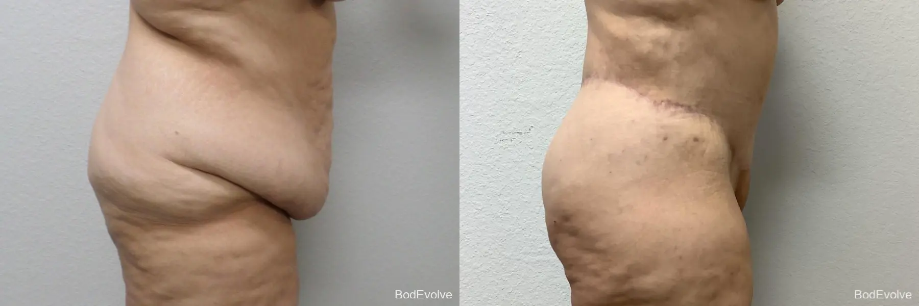 Body Lift: Patient 3 - Before and After 3