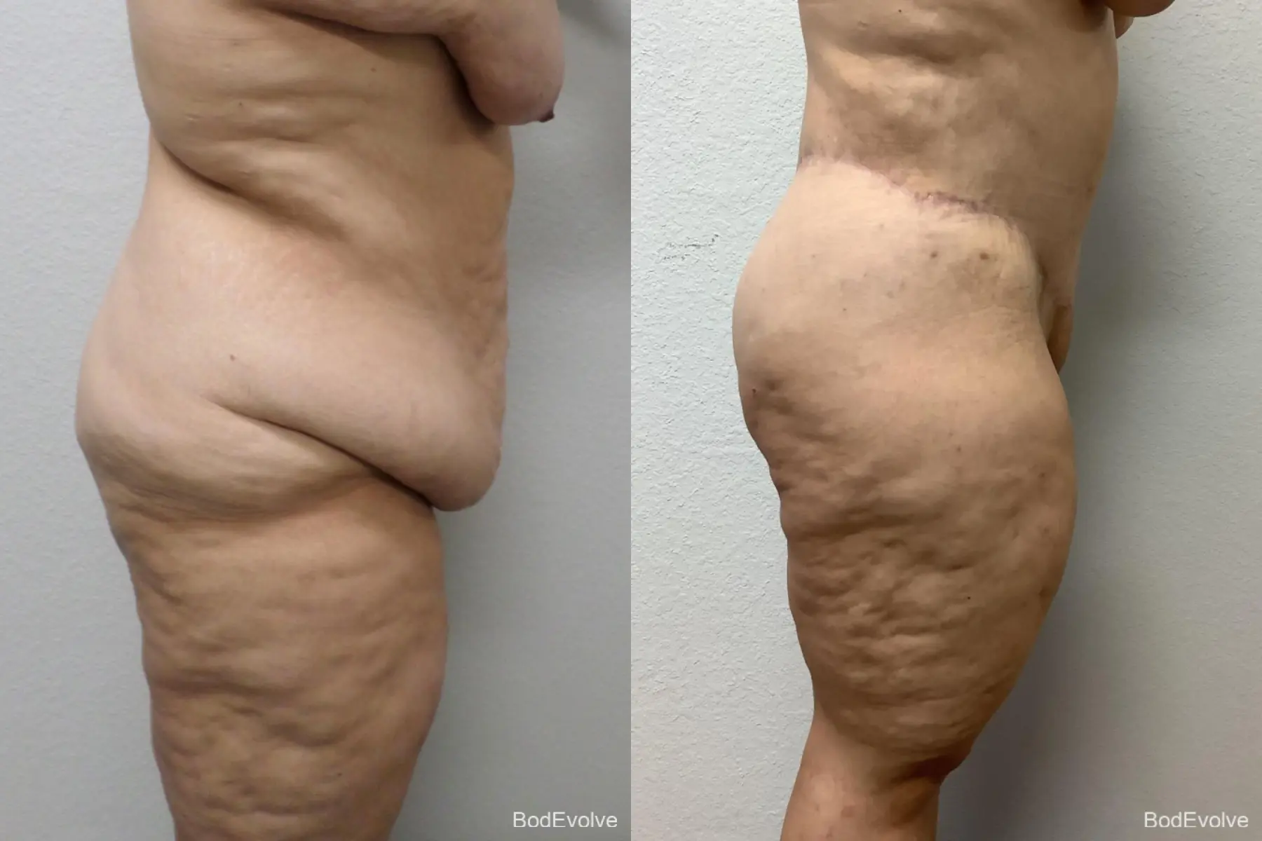 Body Lift: Patient 9 - Before and After 3