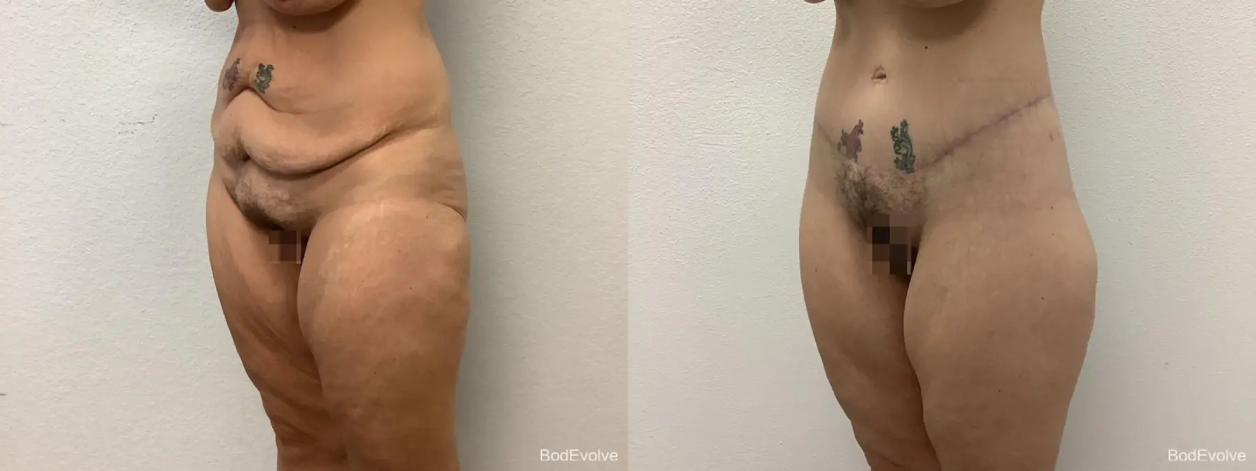 Body Lift: Patient 1 - Before and After 2