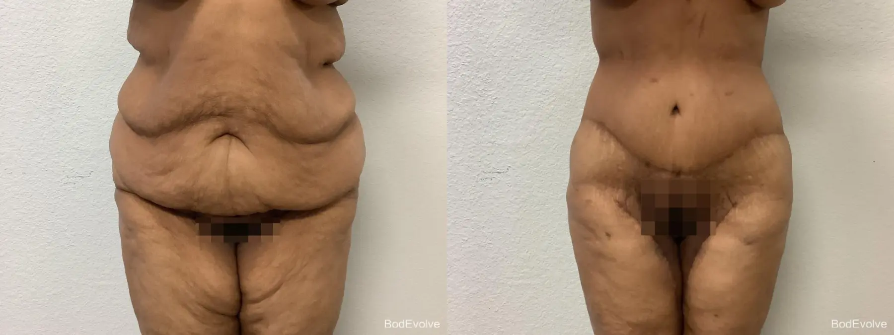 Body Lift: Patient 10 - Before and After  