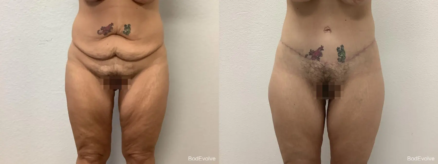 Body Lift: Patient 1 - Before and After  