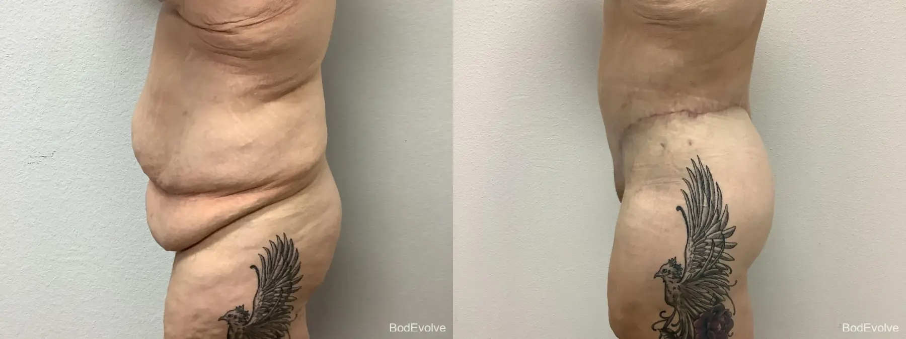 Body Lift: Patient 8 - Before and After 3