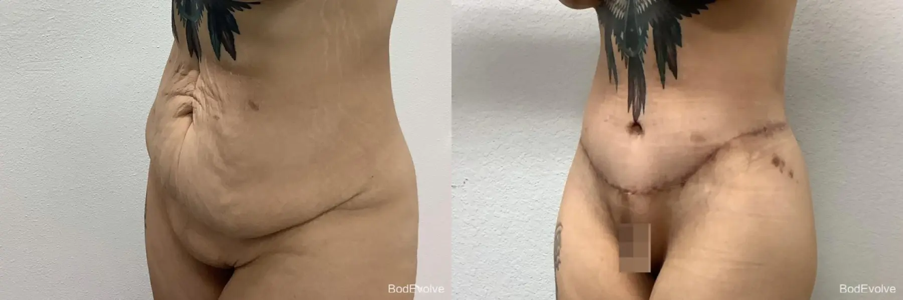 Body Lift: Patient 3 - Before and After 2