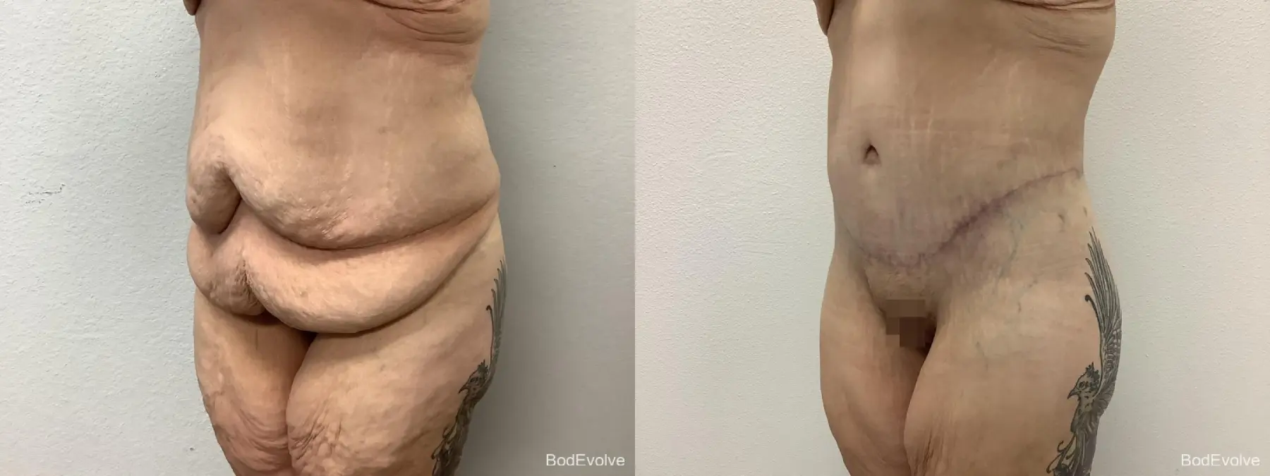 Body Lift: Patient 8 - Before and After 2