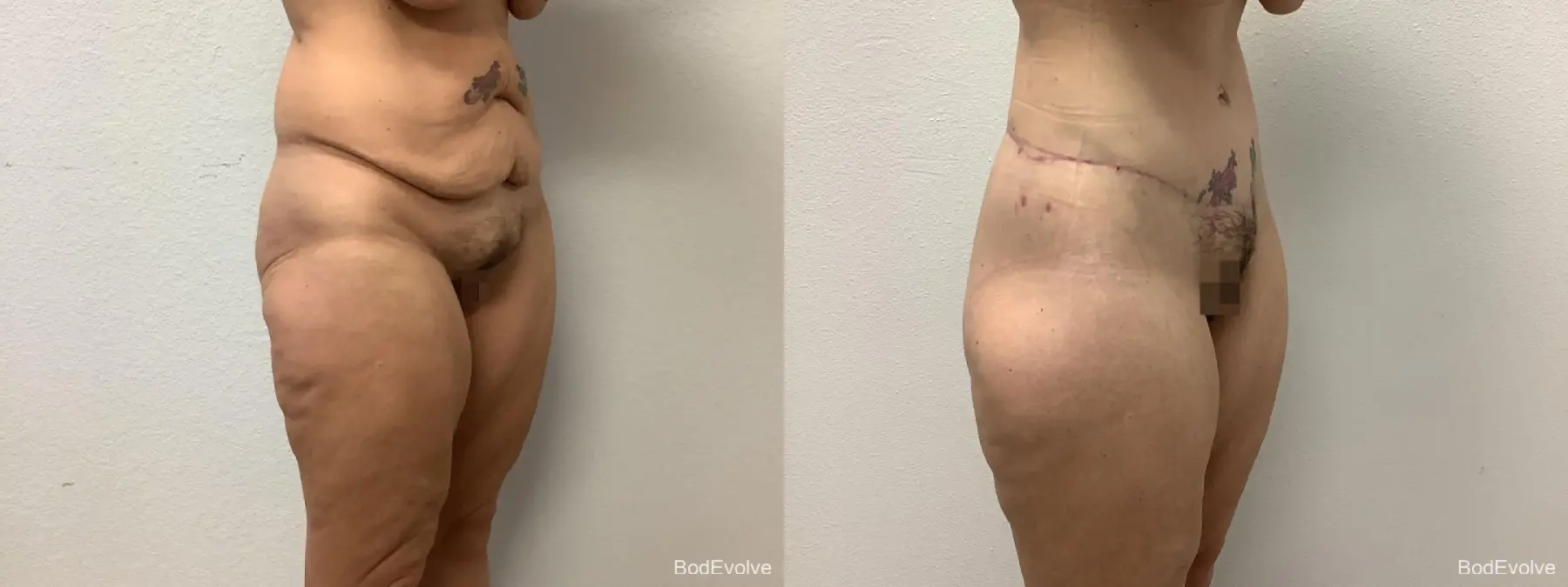 Body Lift: Patient 1 - Before and After 4